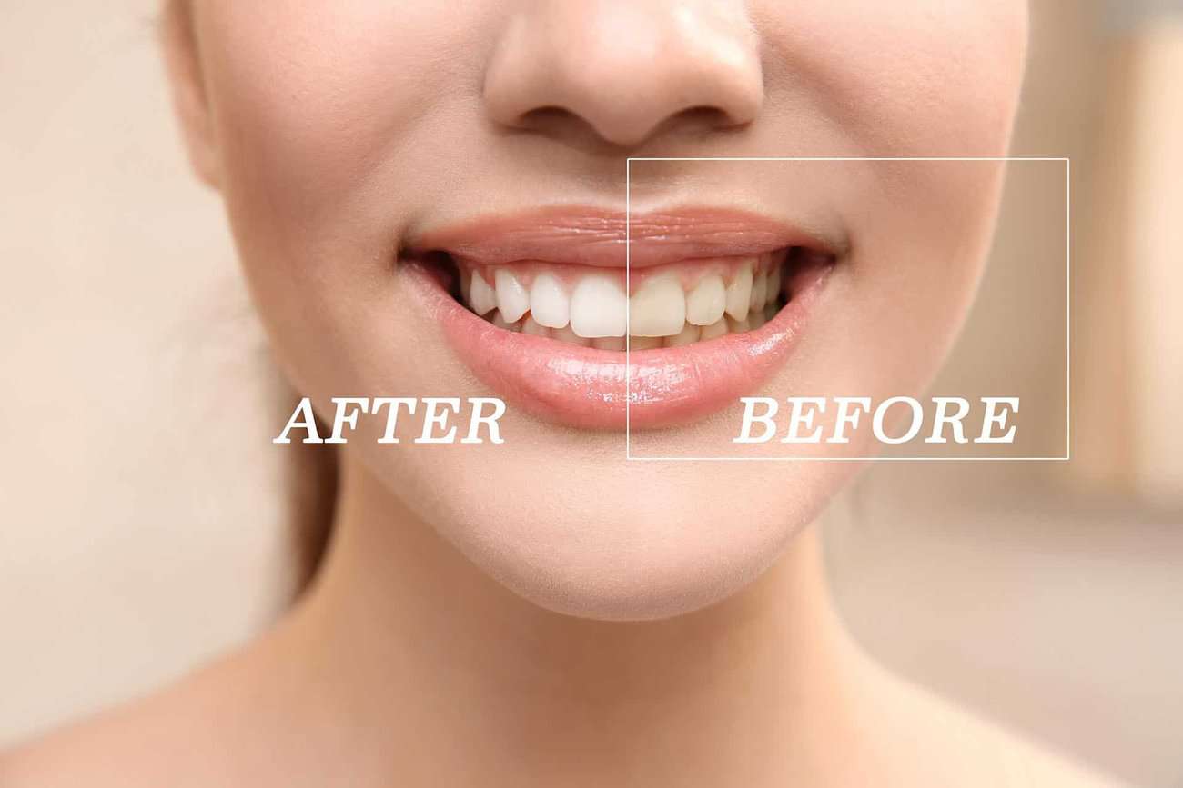 How Can You Maintain a Consistent Smile Shade with Crowns Newbury?