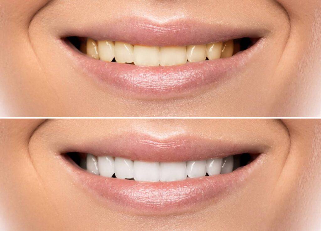 How Does Gum Disease Progress if Left Untreated Newbury?
