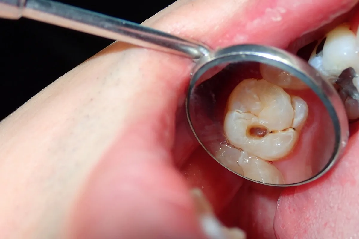 Why Do Teeth Crack? Common Causes to Know Newbury