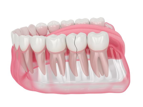 How Can You Manage Pain and Discomfort After a Root Canal Newbury?