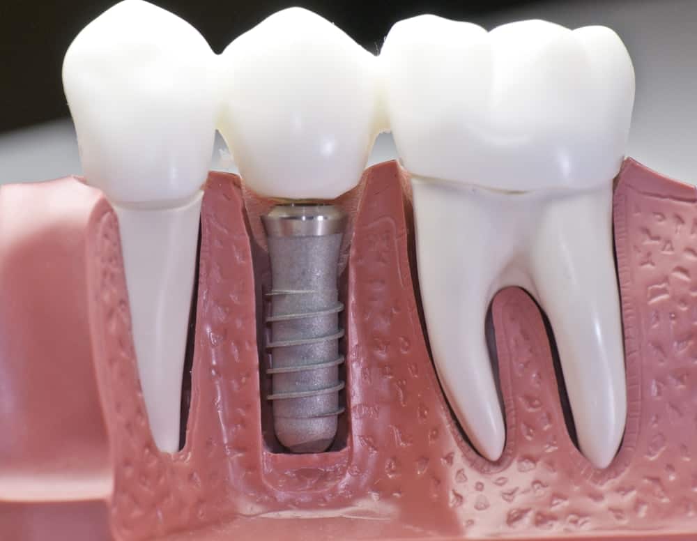 Common Misconceptions About Modern Dental Treatments Newbury