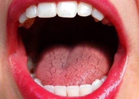 Dry Mouth and Its Role in Tooth Decay Newbury