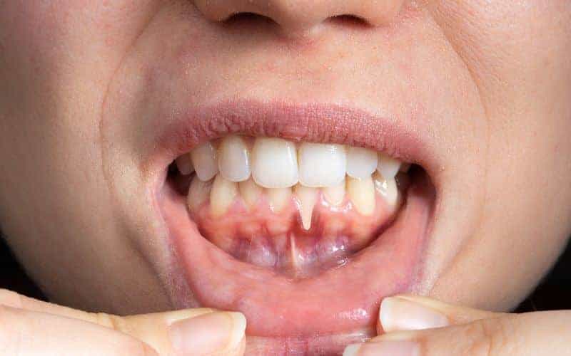 How Can Gum Disease Be Prevented Newbury?