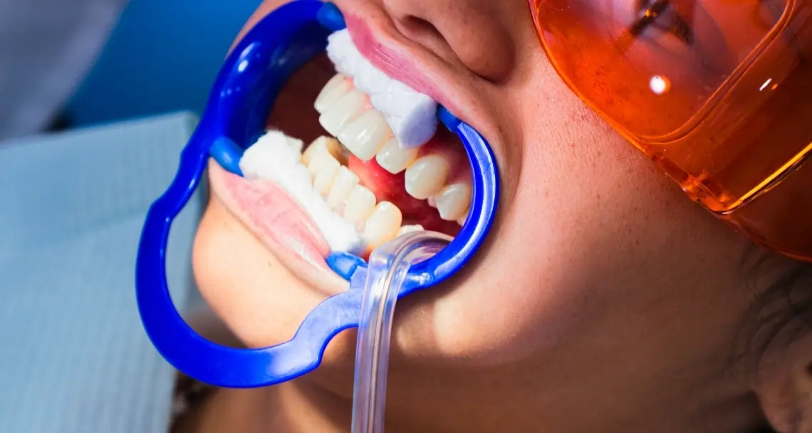 How Teeth Whitening Treatments Actually Work on Your Enamel Newbury