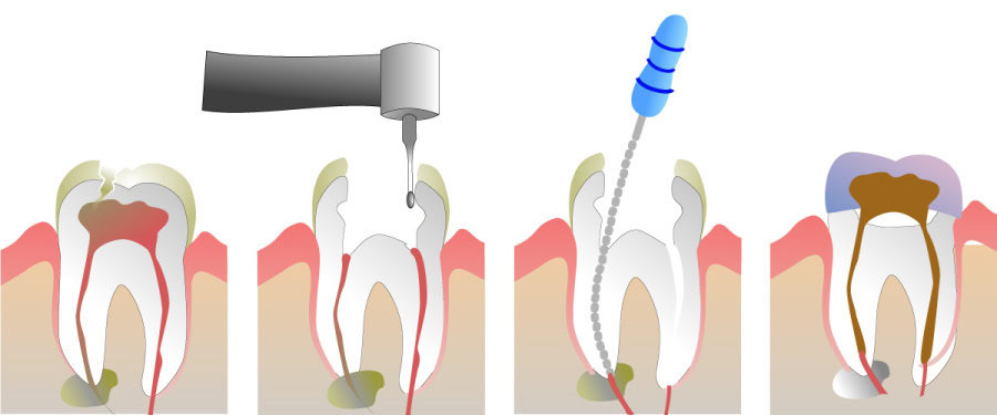 How Do You Properly Care for Your Teeth After a Root Canal Newbury