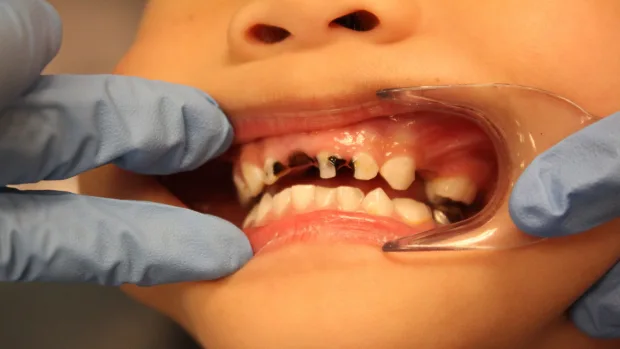 Which Foods and Drinks Cause the Most Damage to Young Smiles Newbury?