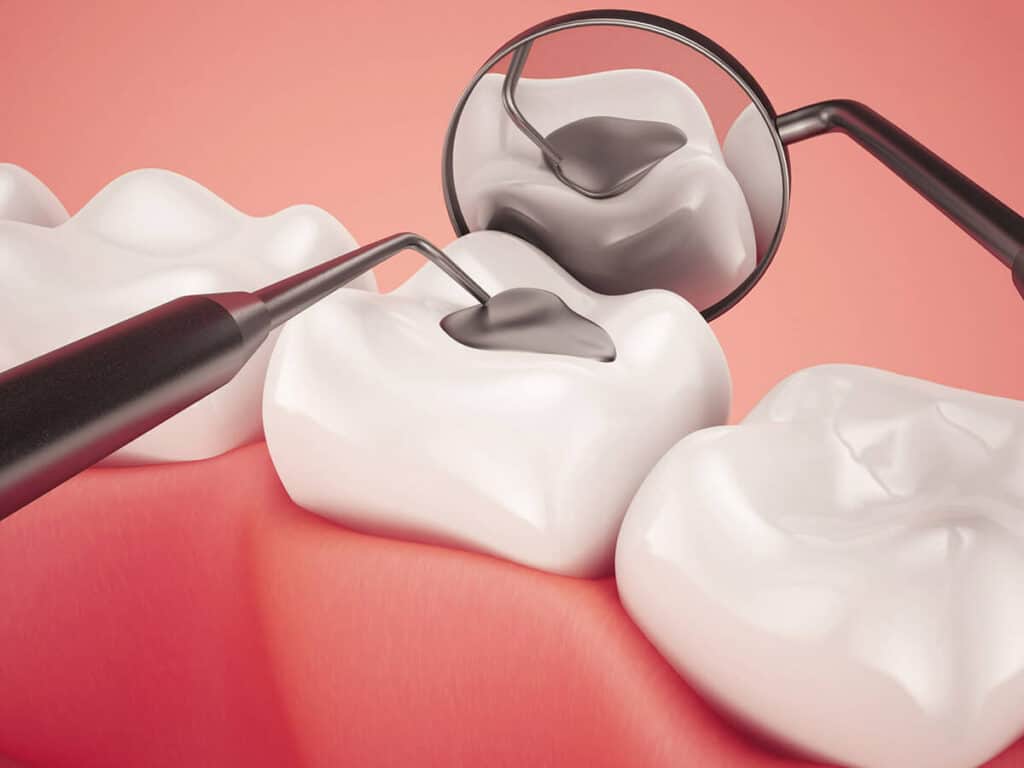 How Can You Prevent Tooth Decay Effectively Newbury