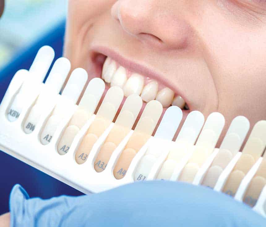 What Happens During Laser Teeth Whitening and How Long the Results Usually Last Newbury