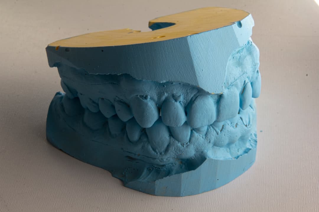How Do Dental Implants Improve Jawbone Health and Oral Function Newbury?