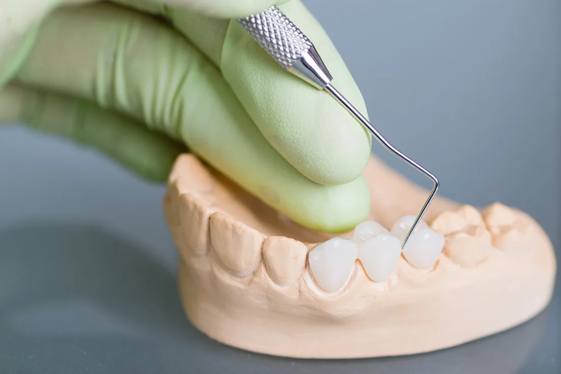 What Are the Different Types of Dental Crowns Available Newbury?