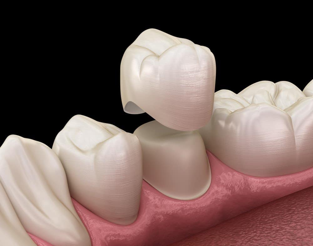 How Can You Prevent Common Dental Crown Problems Newbury?