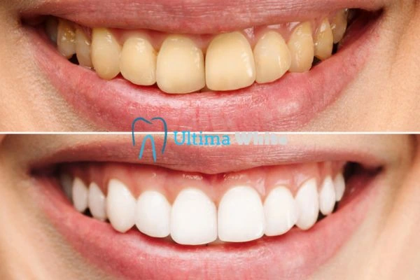 Oral Care Tips for Current and Former Smokers Newbury