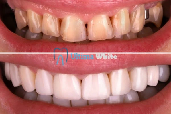 What Makes Instant Teeth Whitening Treatments So Popular Newbury?